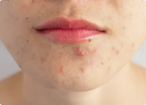 Pustules are pimples with pus inside.
