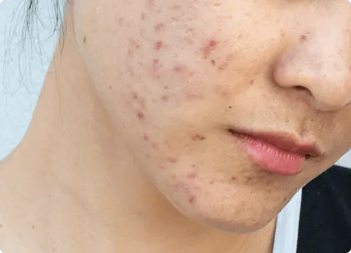 Papules are small pink bumps that don’t contain