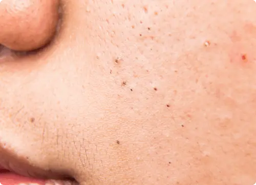 Blackheads are very small dark spots.