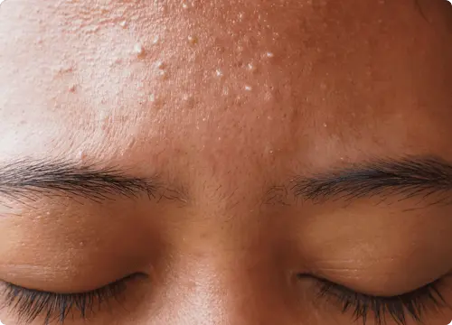 Whiteheads are small raised bumps that can be white or the same color as your skin